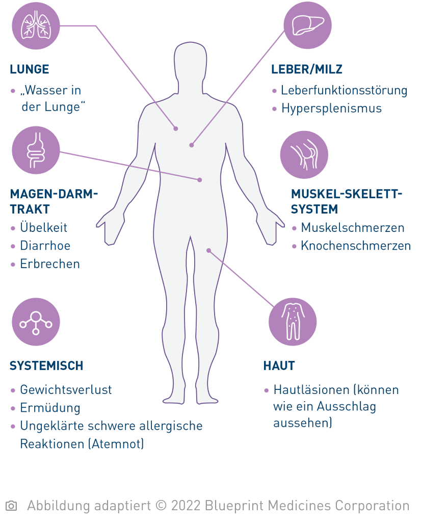 Vereinfachte Illustration eines menschlichen Körpers mit Hinweispfeilen auf die einzelnen Organe: Bei der systemischen Mastozytose treten verschiedene Symptome auf.