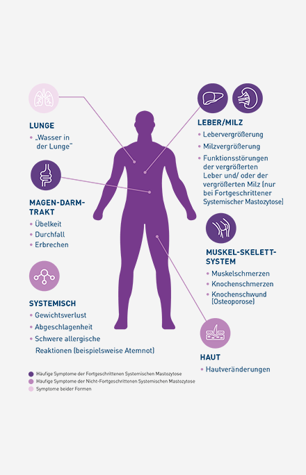 Vereinfachte Illustration eines menschlichen Körpers mit Hinweispfeilen auf mögliche betroffene Organe: Bei der Systemischen Mastozytose können unterschiedliche Symptome auftreten.