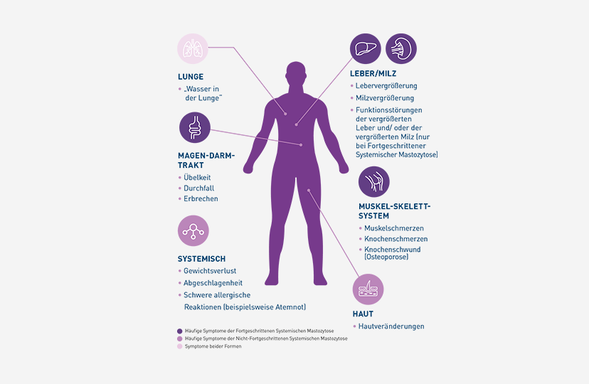 Vereinfachte Illustration eines menschlichen Körpers mit Hinweispfeilen auf mögliche betroffene Organe: Bei der Systemischen Mastozytose können unterschiedliche Symptome auftreten.