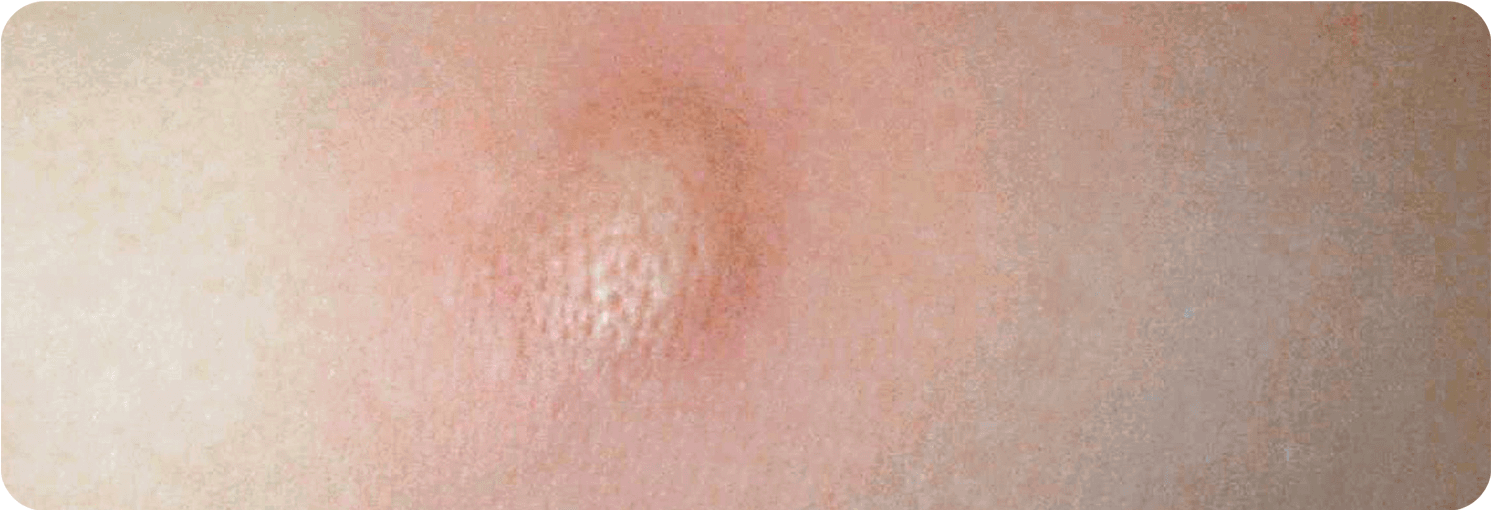 Fotos von der Haut von Patienten mit Kutaner Mastozytose, sichtbar durch Verfärbungen der Haut und Quaddeln.