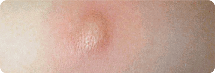 Fotos von der Haut von Patienten mit Kutaner Mastozytose, sichtbar durch Verfärbungen der Haut und Quaddeln.