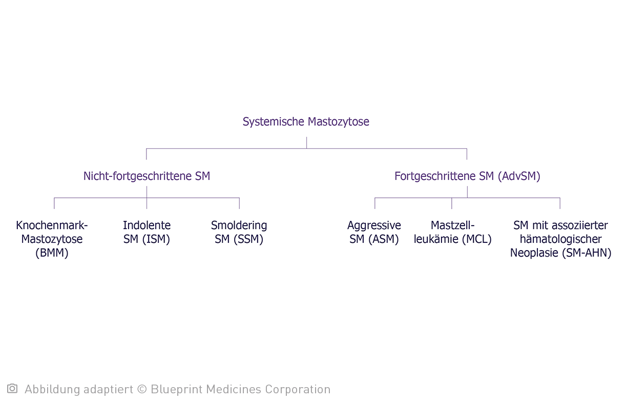 Baumdiagramm der Systemischen Mastozytose unterteilt in Nicht-fortgeschrittene SM und Fortgeschrittene SM (AdvSM) und deren Subtypen.