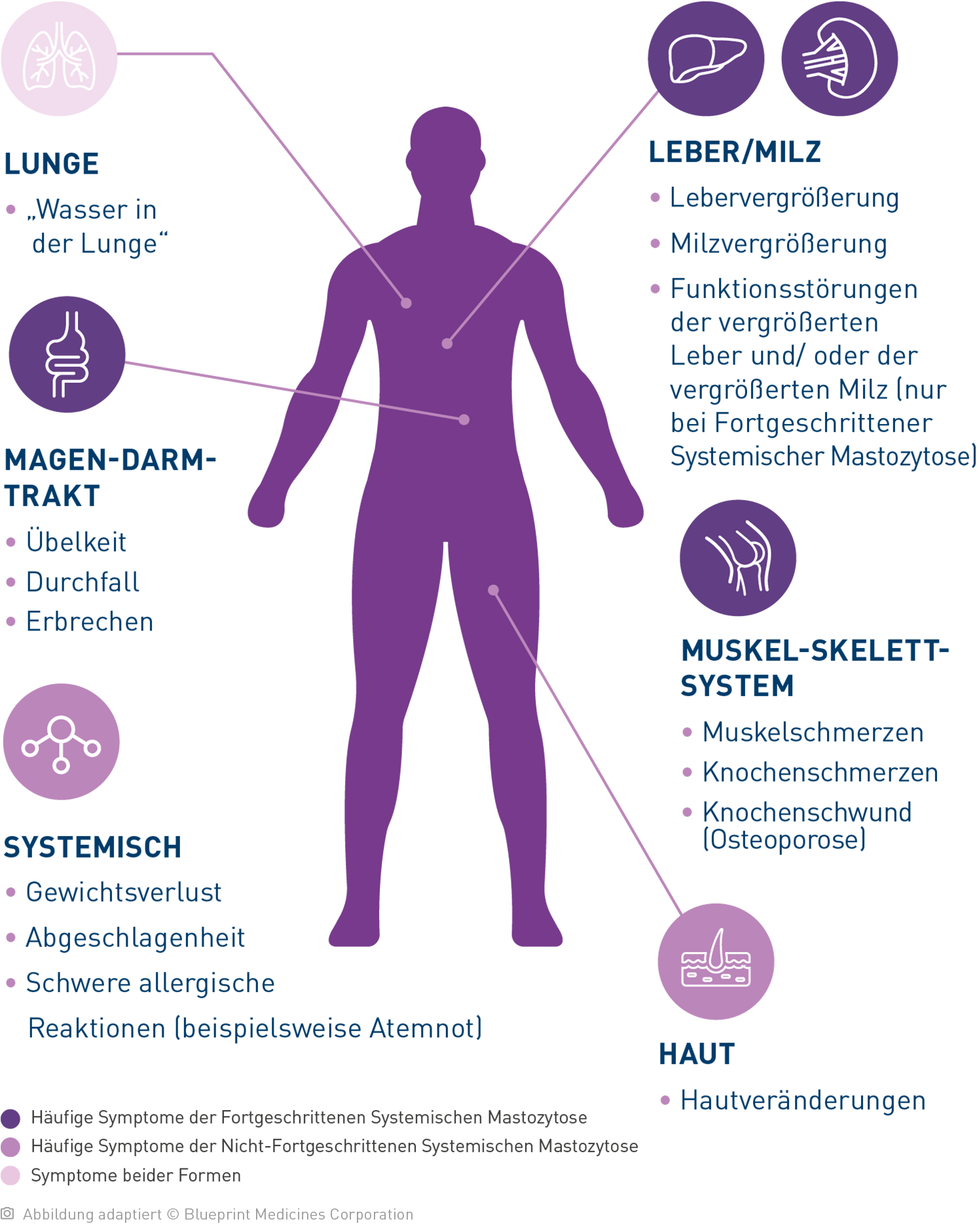 Vereinfachte Illustration eines menschlichen Körpers mit Hinweispfeilen auf die einzelnen Organe: Bei der Systemischen Mastozytose können unterschiedliche Symptome auftreten.