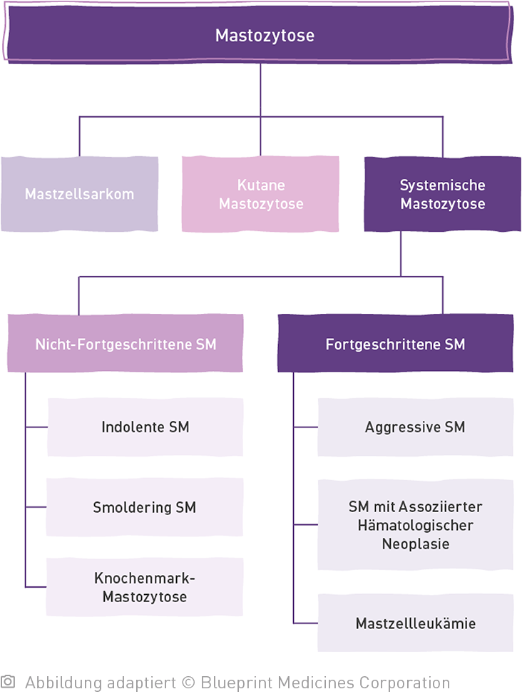 Baumdiagramm der Mastozytose unterteilt in Mastzellsarkom, Kutane Mastozytose und Systemische Mastozytose. Mit einer weiteren Unterteilung der Systemischen Mastozytose in Nicht-Fortgeschrittene SM und Fortgeschrittene SM.
