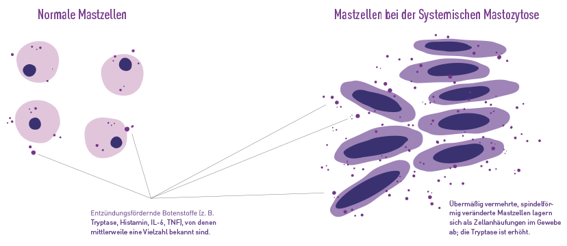Grafik zur Verdeutlichung der Unterschiede normalen Mastzellen und spindelförmiger Mastzellen der Systemischen Mastozytose.