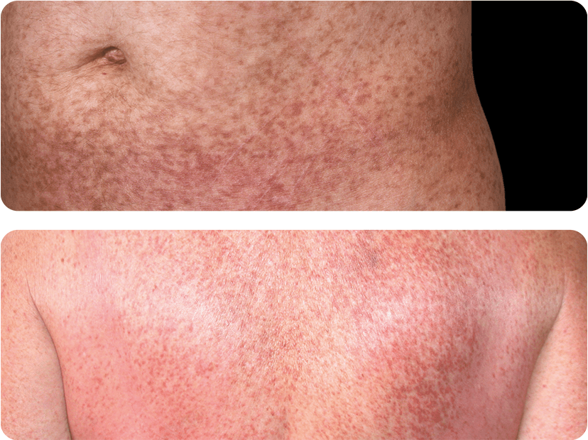 Fotos von der Haut von Patienten mit Kutaner Mastozytose, sichtbar durch Verfärbungen der Haut und Quaddeln.